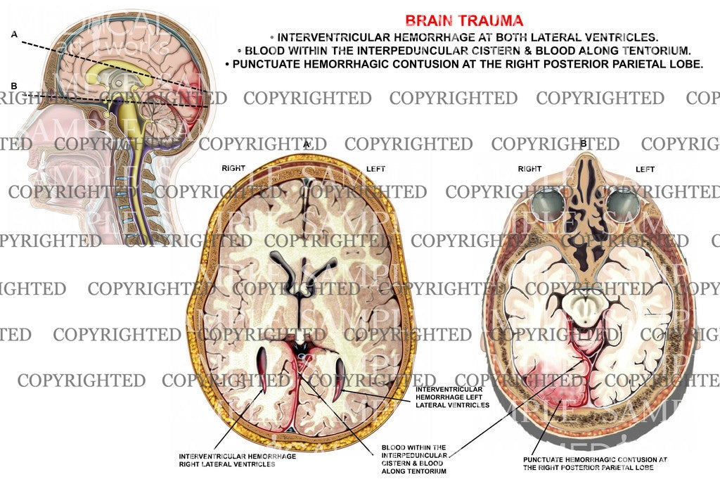 Brain trauma-interventricular hemorrahge