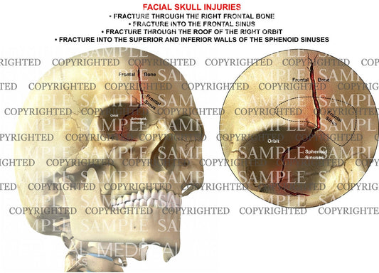 Facial skull injuries
