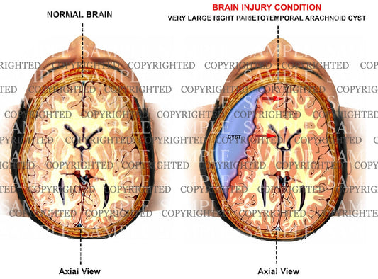 Brain subarachnoid cyst