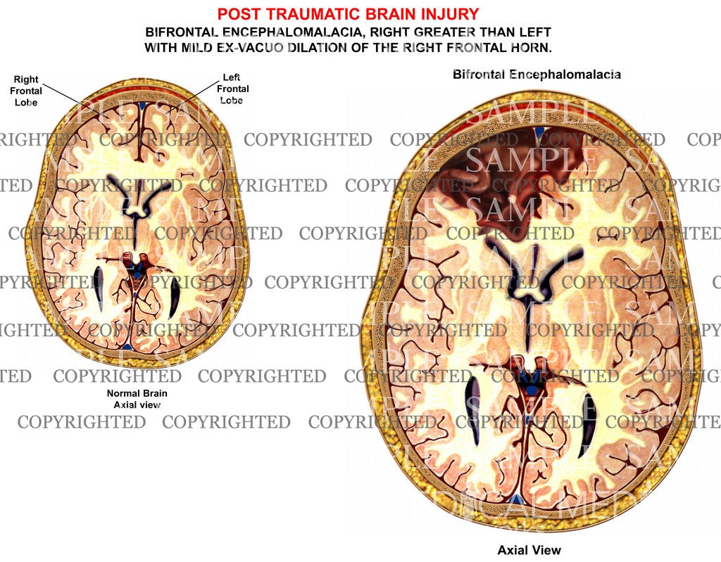 Post traumatic brain injury