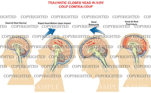 Traumatic closed head - mechanism of injury