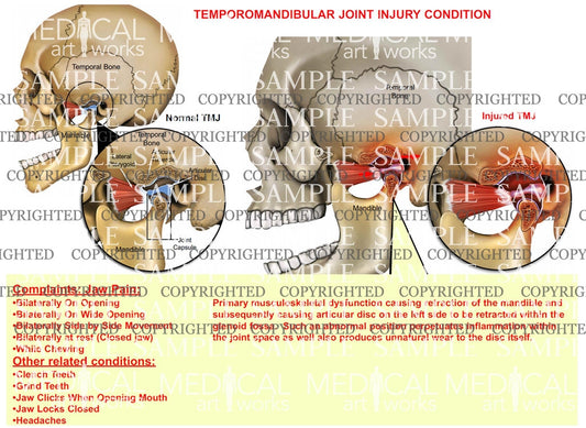 Temporomandibular Joint Injury