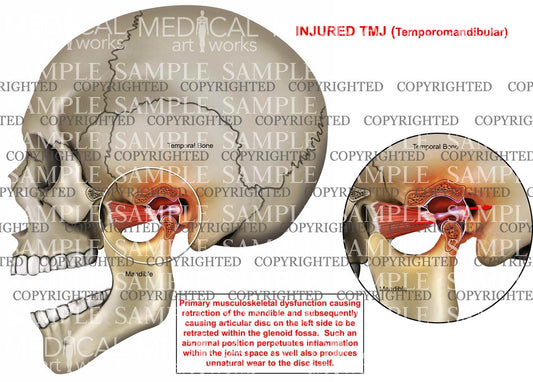 Temporomandibular Joint Injury1