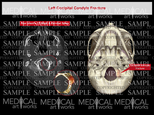 Occipital condyle fracture-Left
