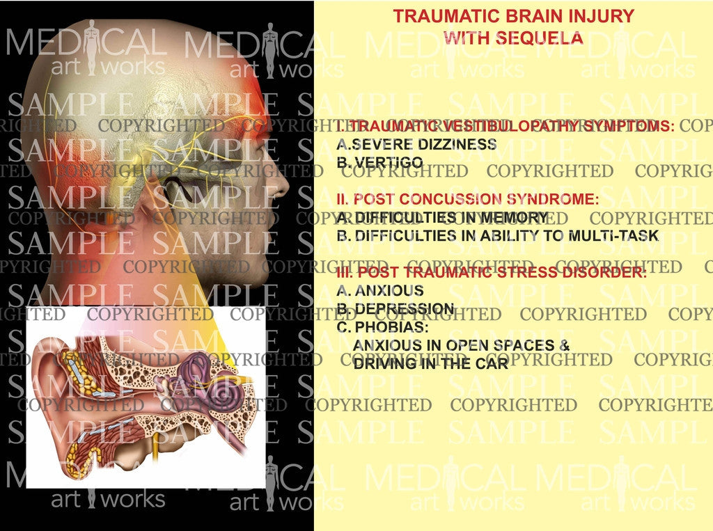 Traumatic Brain Injury with sequela