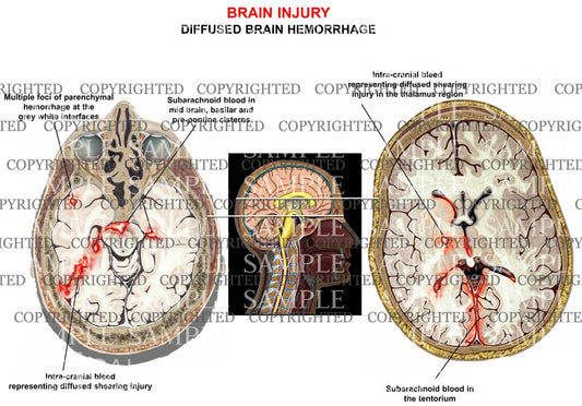 Brain trauma-diffused hemorrhage