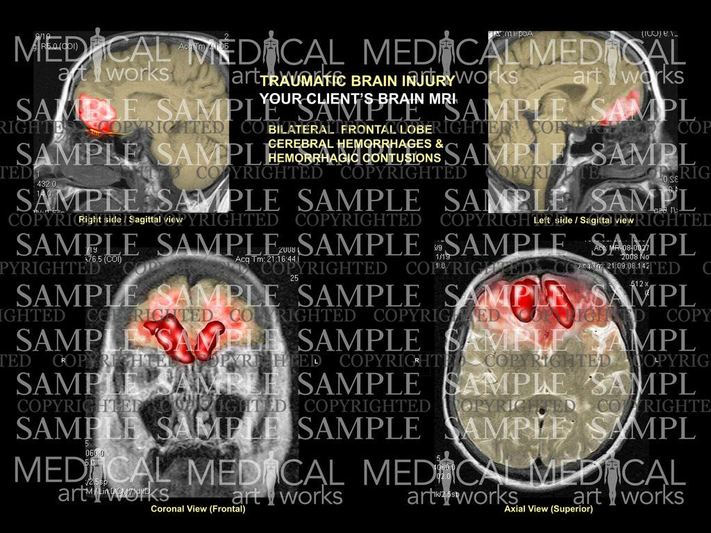 Traumatic brain injury - MRI colorization