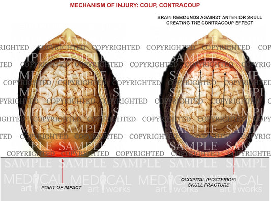 Mechanism of coup, contracoup injury