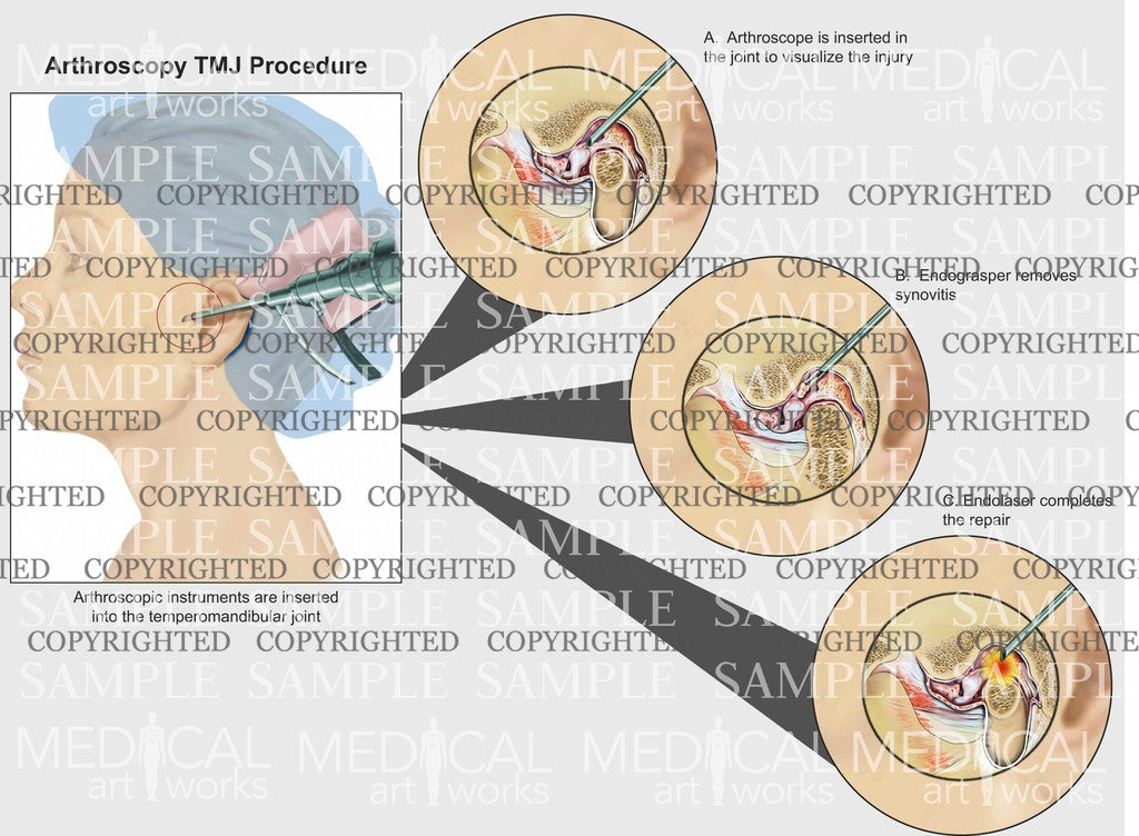 Arthroscopic TMJ procedure