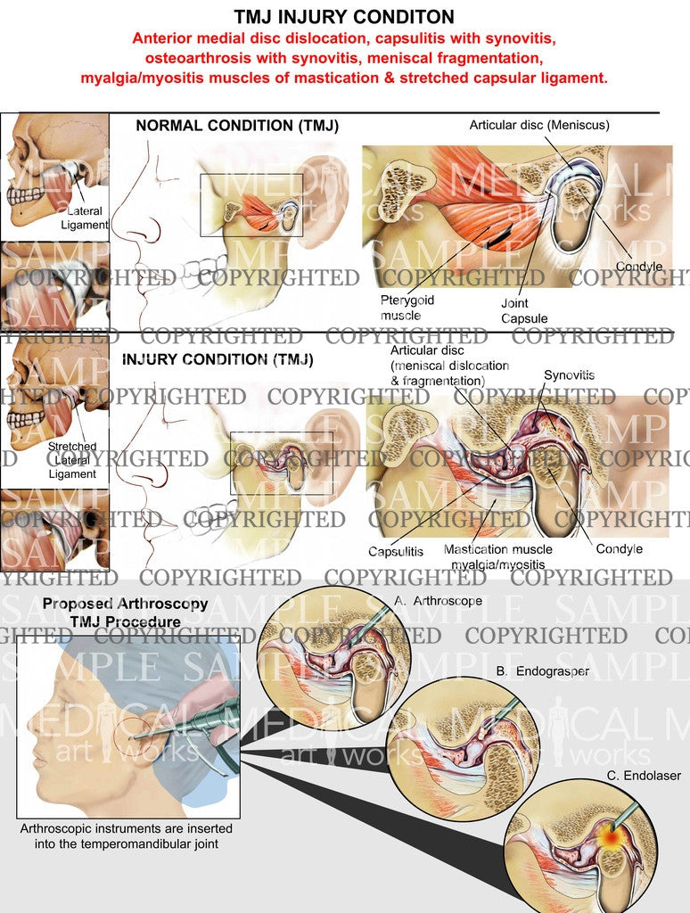 Bilateral TMJ+muscles & arthroscopic procedure2