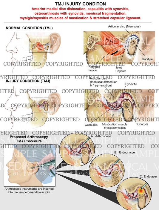 Bilateral TMJ & arthroscopic procedure