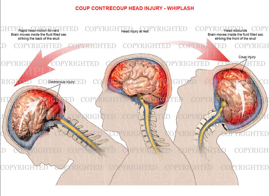 Mechanism of coup, contrecoup injury - Whiplash