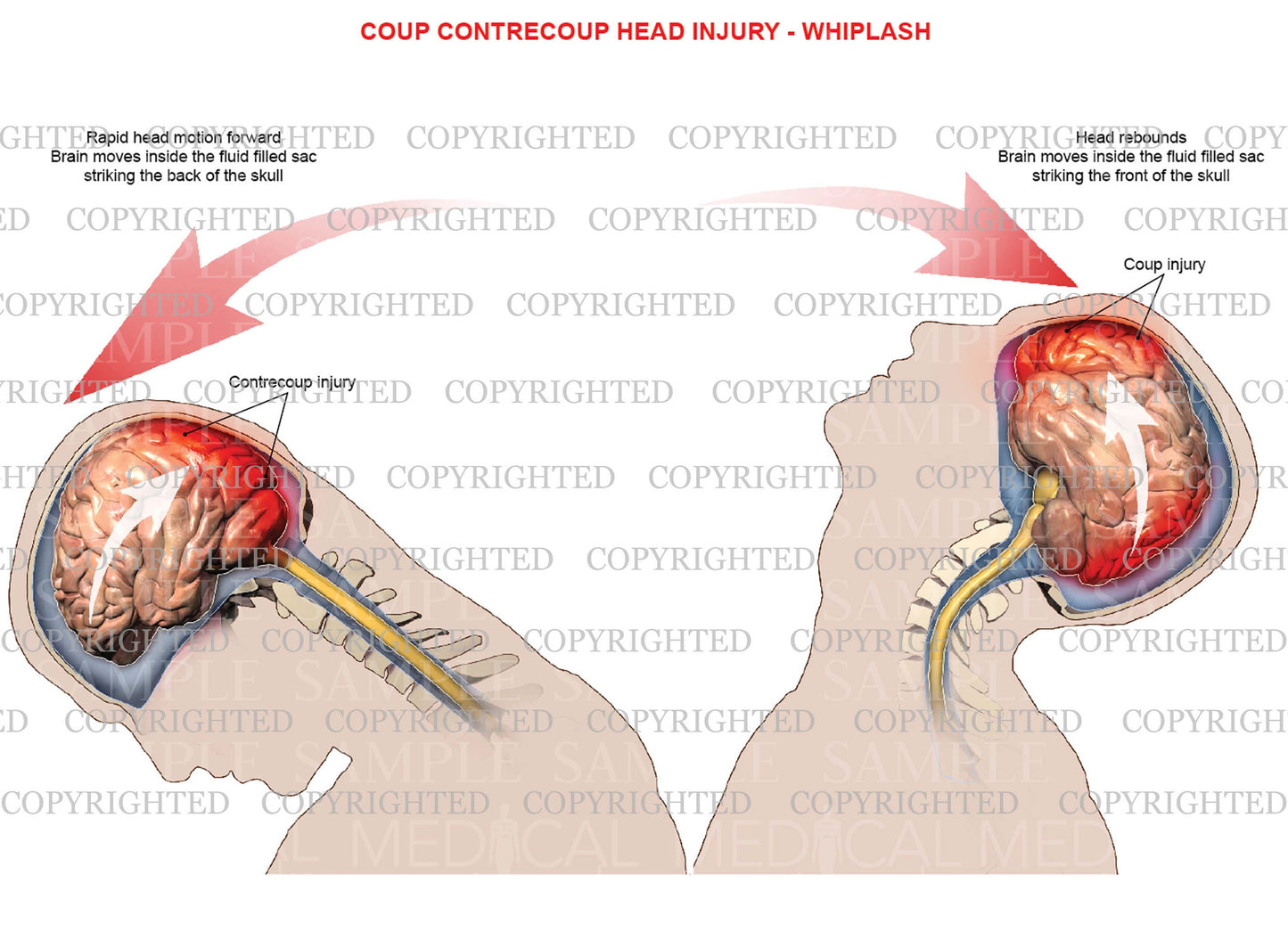 Mechanism of coup, contrecoup head injury - Whiplash