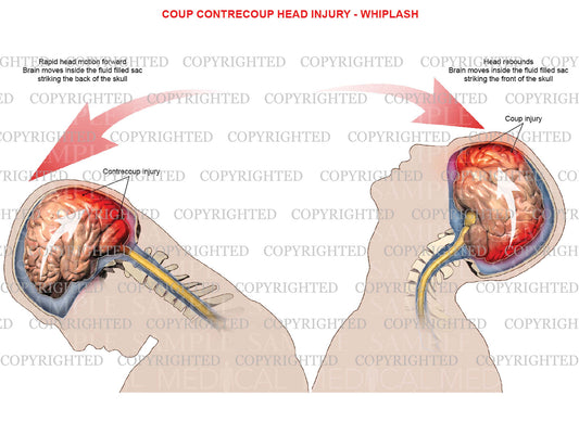 Mechanism of coup, contrecoup head injury - Whiplash