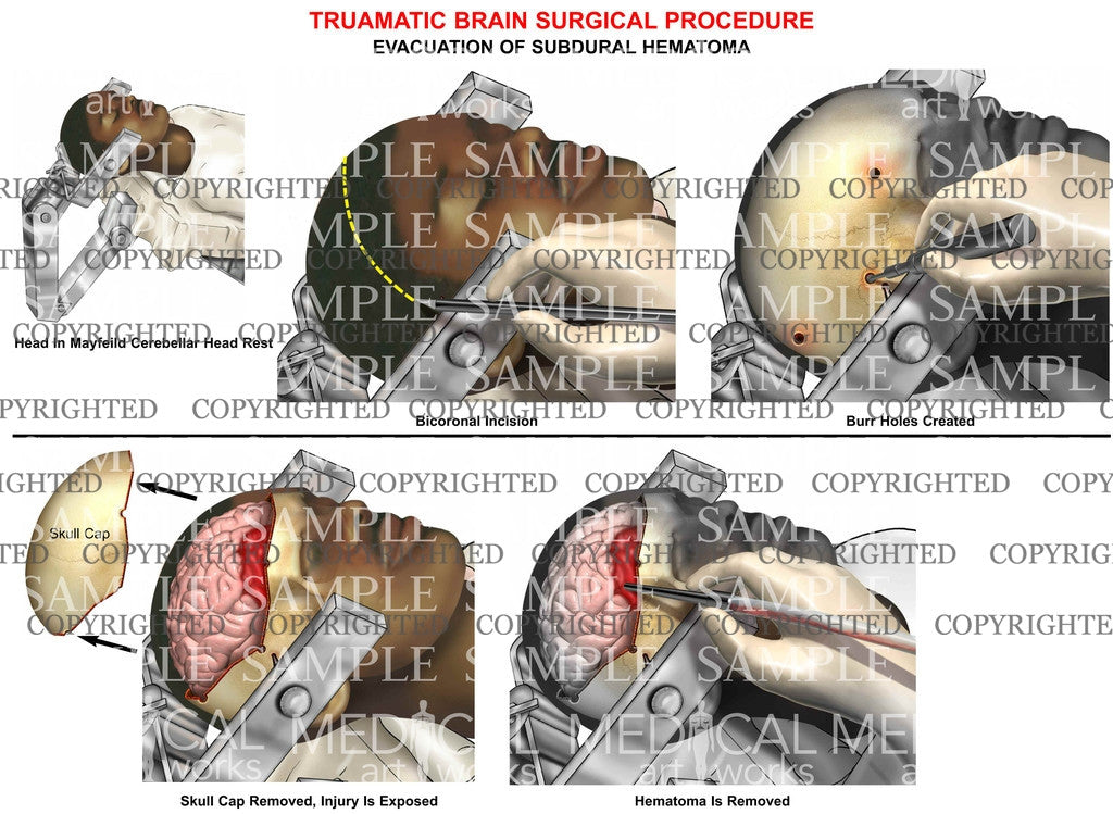 Traumatic brain - Hemicraniotomy surgery