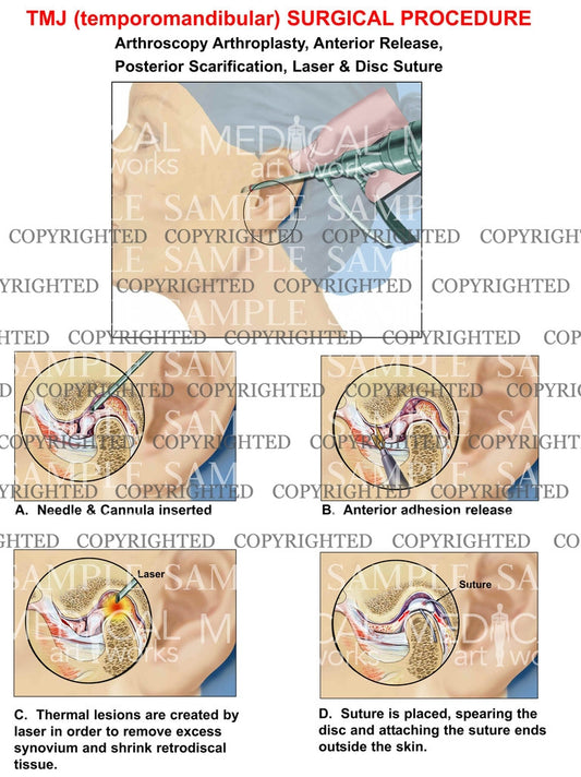 TMJ (temporomandibular) Surgical Procedure