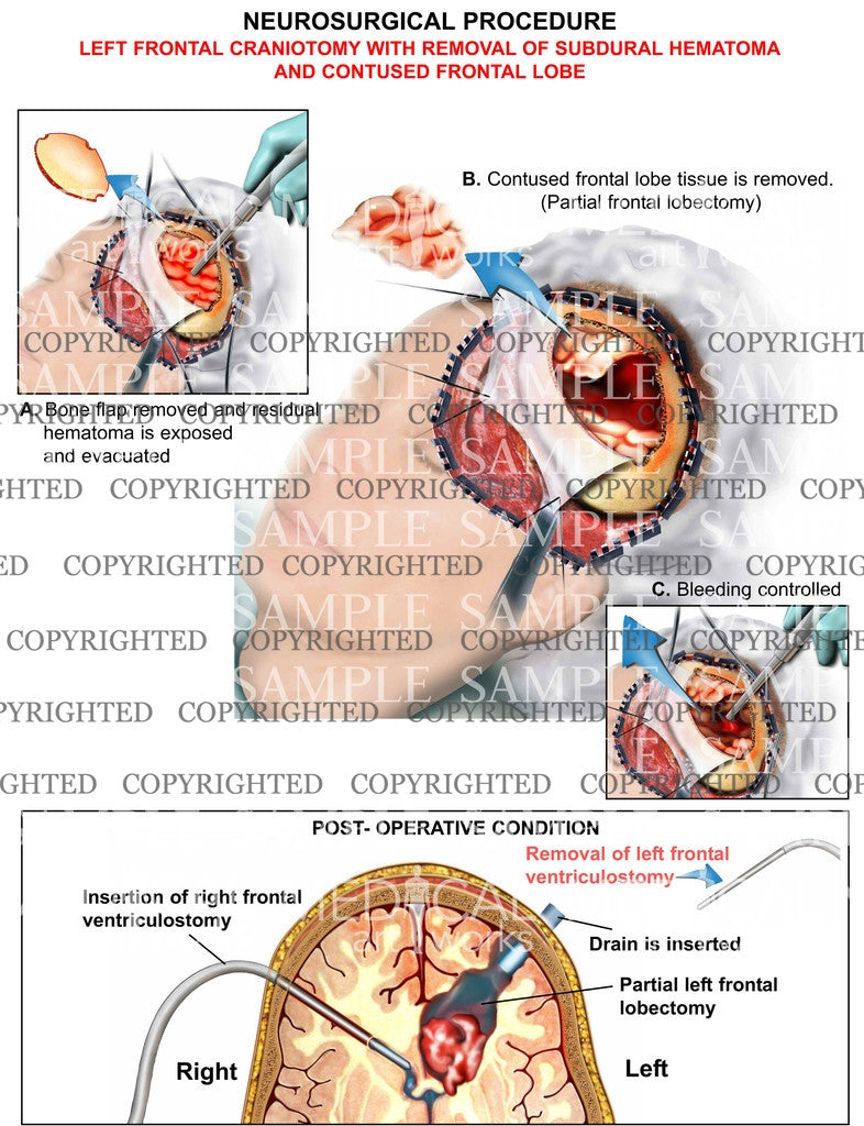 Frontal craniotomy