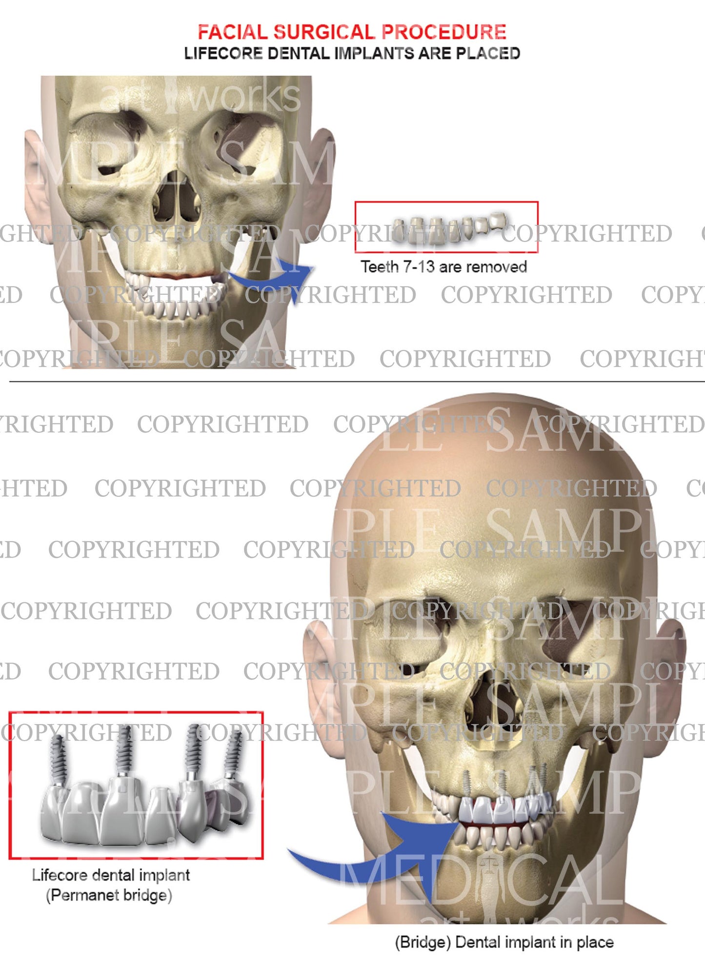 Oral maxilla-facial surgery with lifecore implants