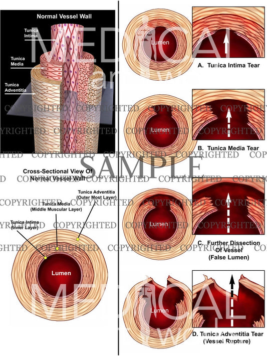 Normal Vessel Wall and tear