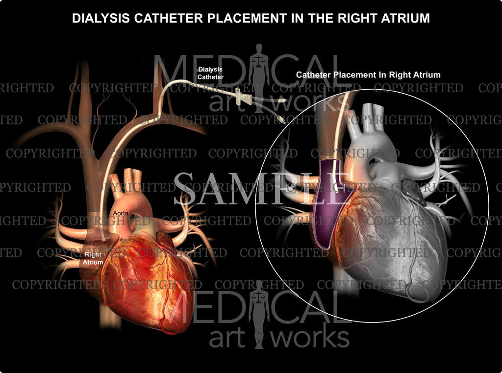 Heart catheterization