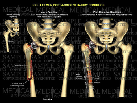 Right Femur Post-Accident injury Condition