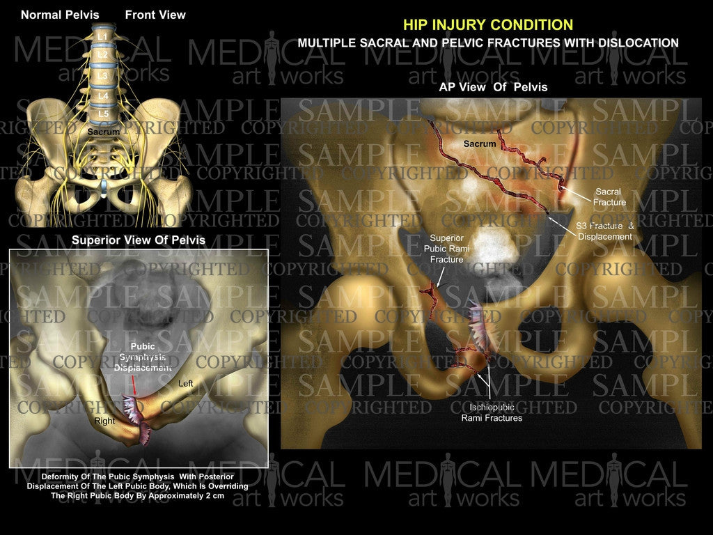 Hip pelvic sacral fractures