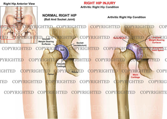 Right hip joint arthritis