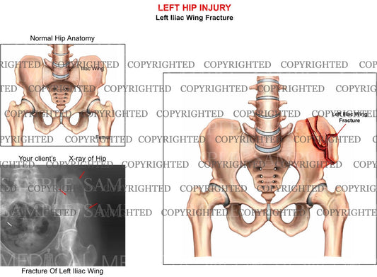 Left hip iliac wing fracture