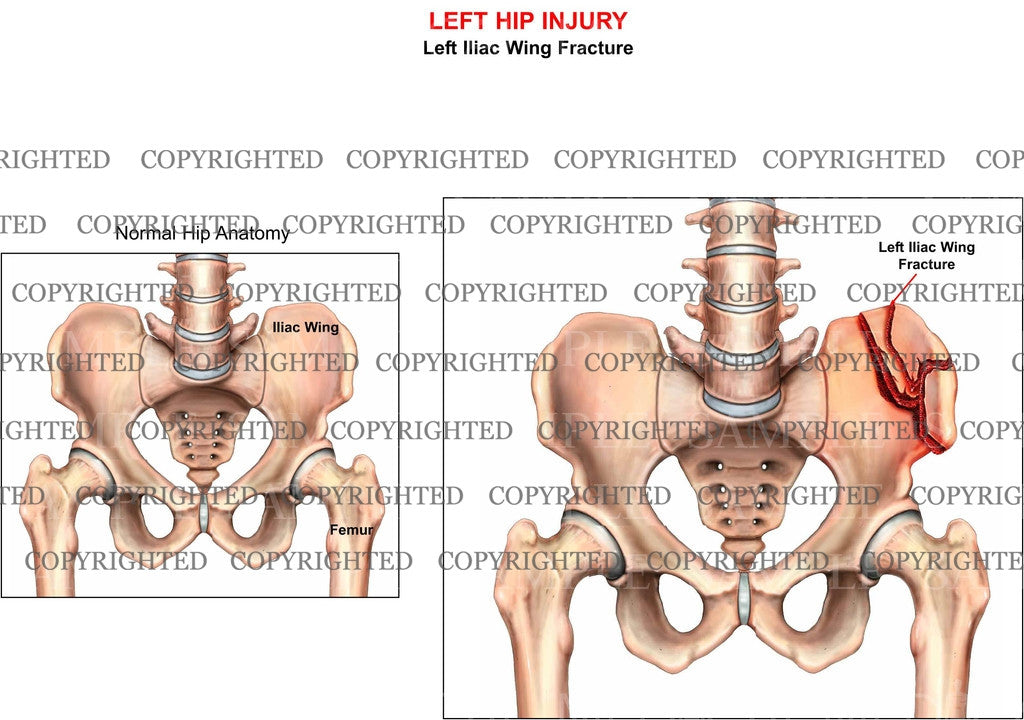 Left hip iliac fractures