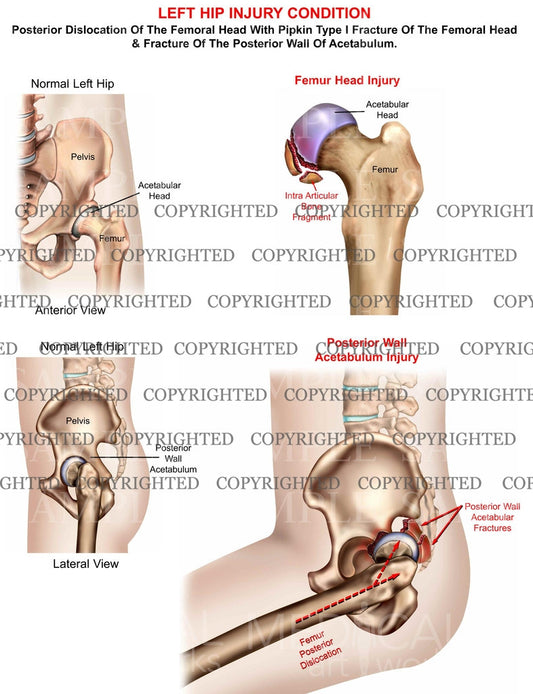 Left hip posterior dislocation with Pipkin fracture