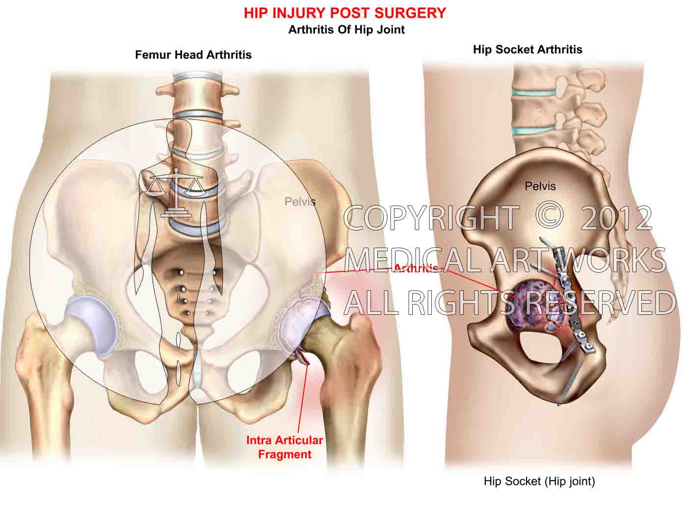 Hip post-op acetabulaum arthritis