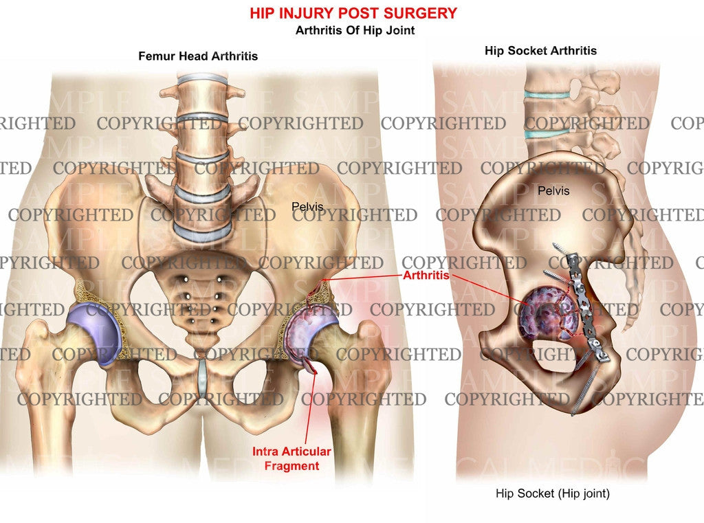 Hip post-op acetabulaum arthritis