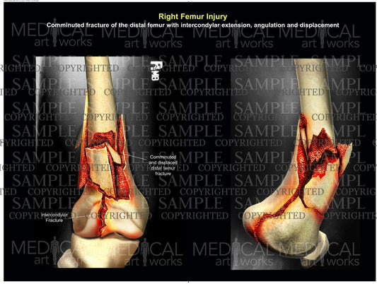 Right femur injury / fracture