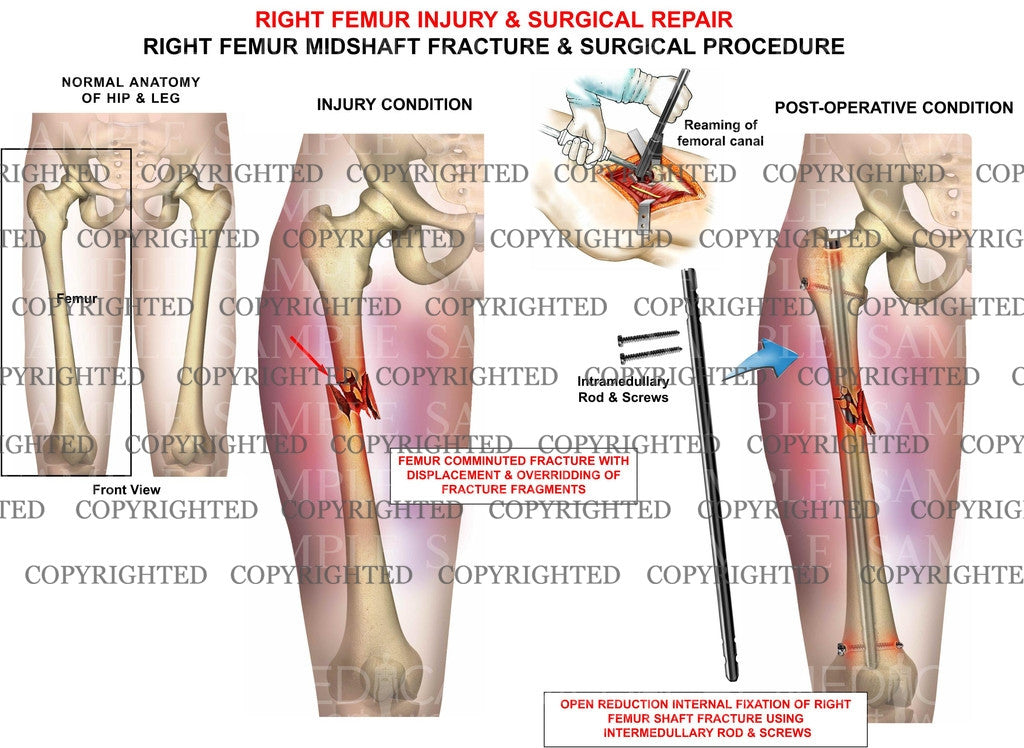 Right femur injury & surgery