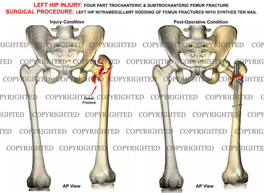 Left femur 4 part intertrochanteric fracture