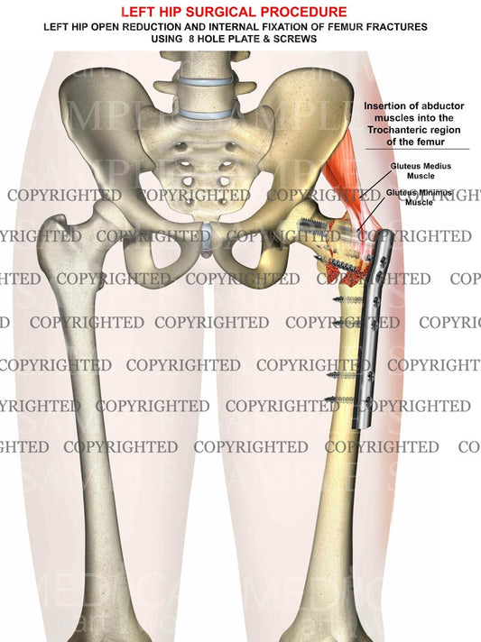 Left femur intertrochanteric fracture - ORIF