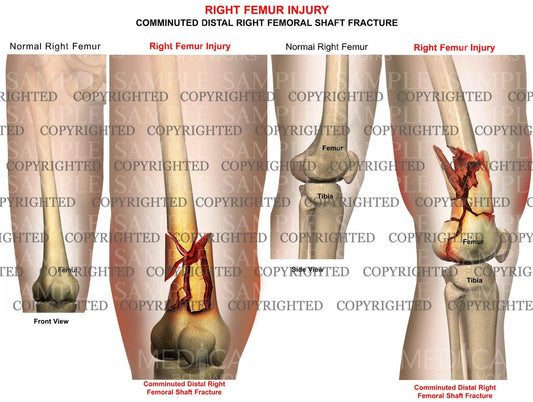 Right Femur injury fracture