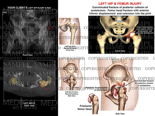 Left acetabulum and femur head fracture