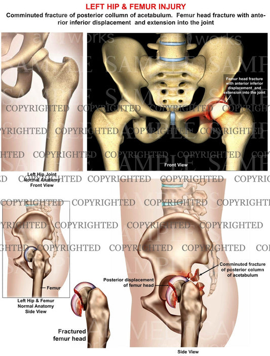 Left acetabulum posterior column fracture
