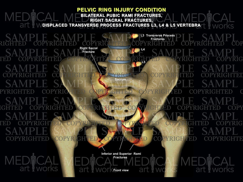 Bilateral hip rami, sacral fractures