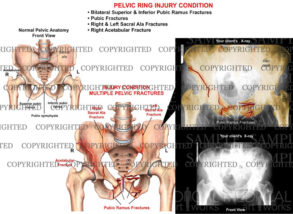 PELVIC RING Injury condition
