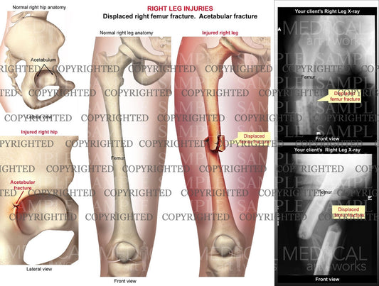 Right femur shaft fracture