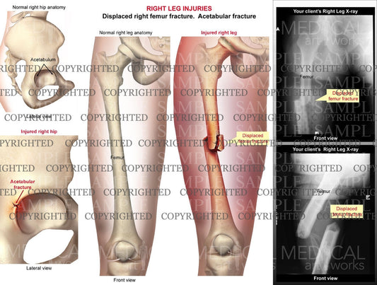 Right femur shaft fracture
