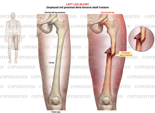 Left femur displaced femoral shaft fracture