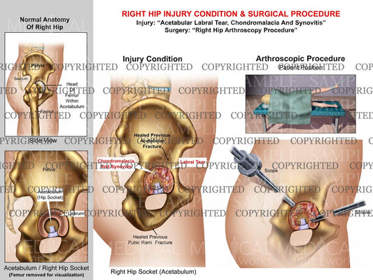 Right hip labral tear - arthroscopy