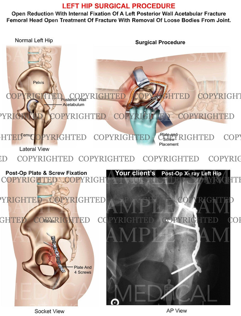 Left hip surgical procedure ORIF
