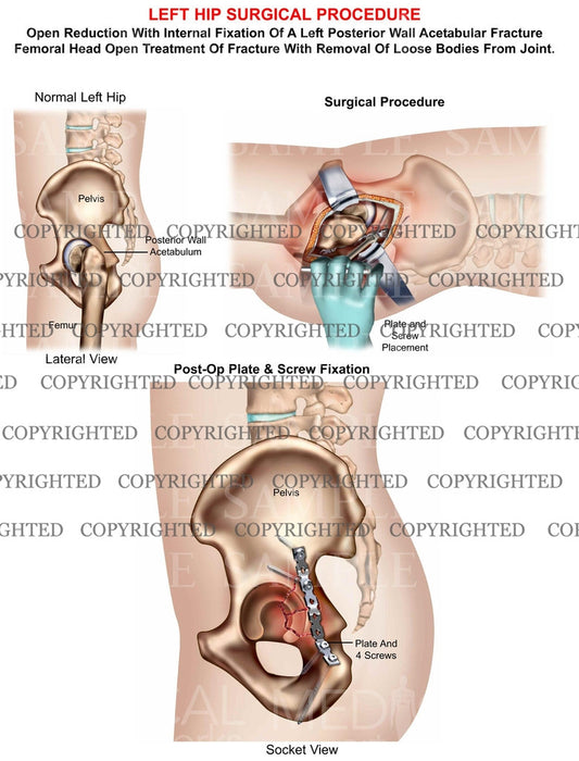 Left hip acetabular fracture surgery, ORIF