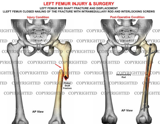 Left femur mid shaft fracture & intramedullary rod