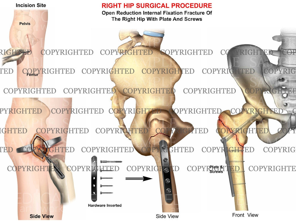 Right hip ORIF, plate and screws fixation