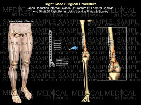 Right femur shaft and condyle surgery